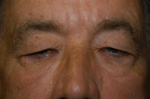 Blepharoplasty 5a